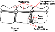 Bone proliferation