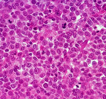 Biopsy specimen of a histiocytoma composed of sheets of round cells. Scattered mitoses are present (Hematoxylin and eosin stain, courtesy of Noah's Arkive, University of Georgia).